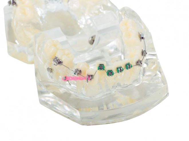 Modello dentale con apparecchi ortodontici