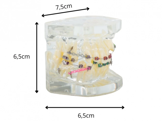 Modello dentale con apparecchi ortodontici