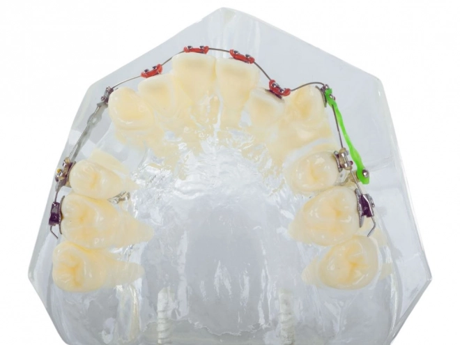 Modello dentale con apparecchi ortodontici