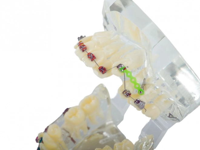 Modello dentale con apparecchi ortodontici
